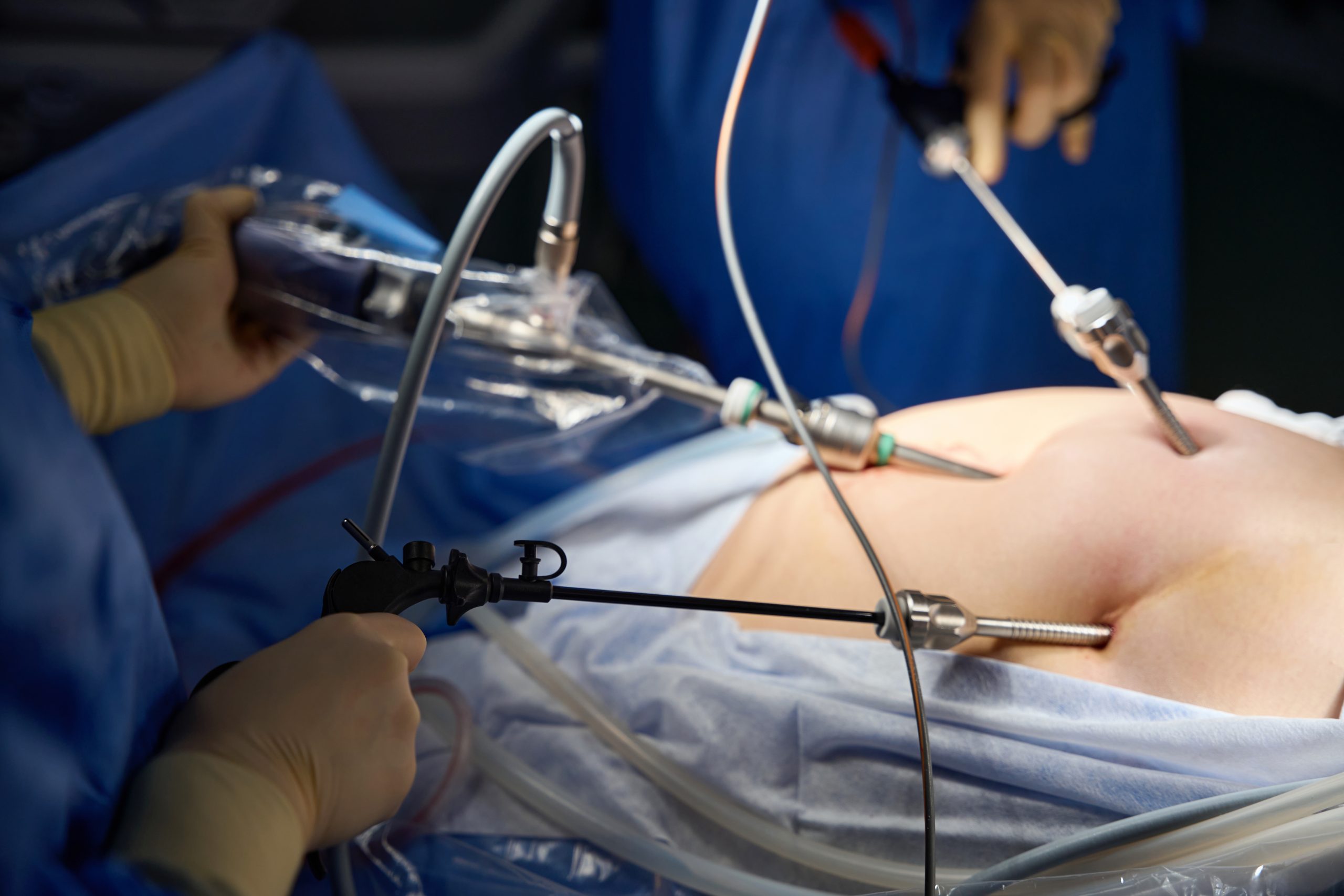 Laparoskopik (Kapalı) Cerrahi