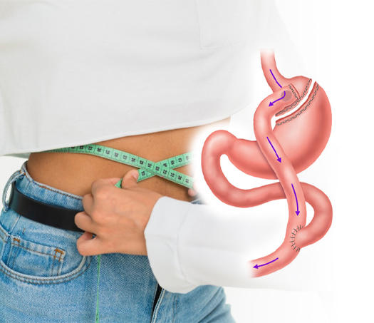 Gastrik Bypass Ameliyatı