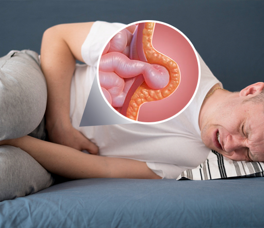 Karın Duvarı Fıtıkları